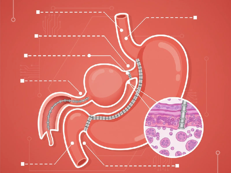 بایپس معده یا اسلیو معده ؟ بررسی تفاوت ها از نگاه بهترین جراح چاقی اسلیوه معده
