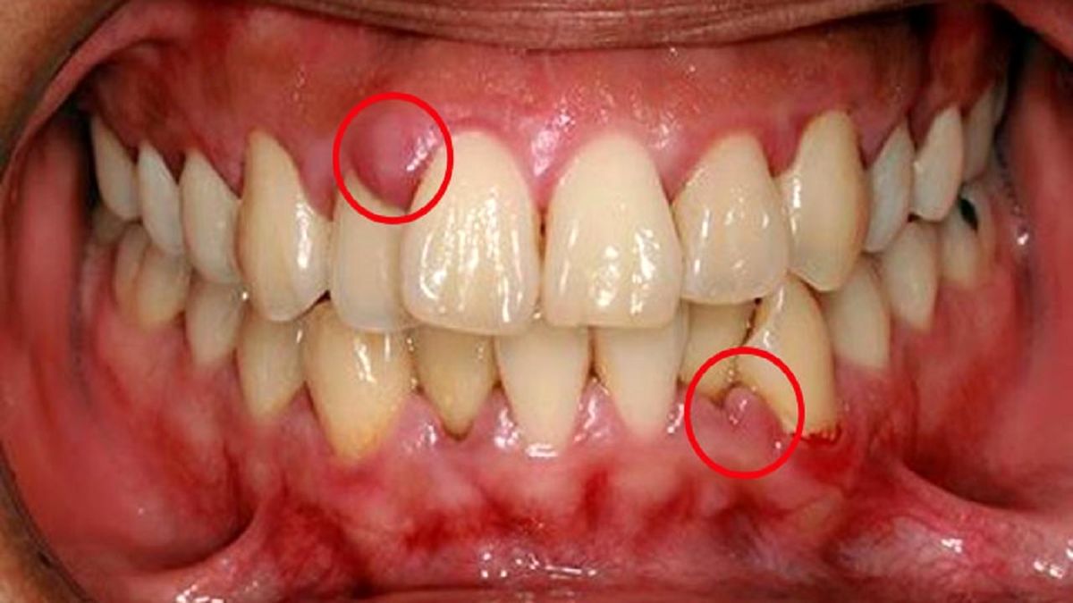 علائم رایج عفونت لثه که باید بدانید