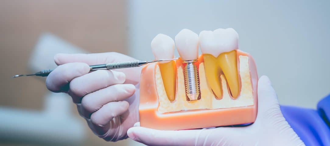 عوارض و خطرات ایمپلنت دندان