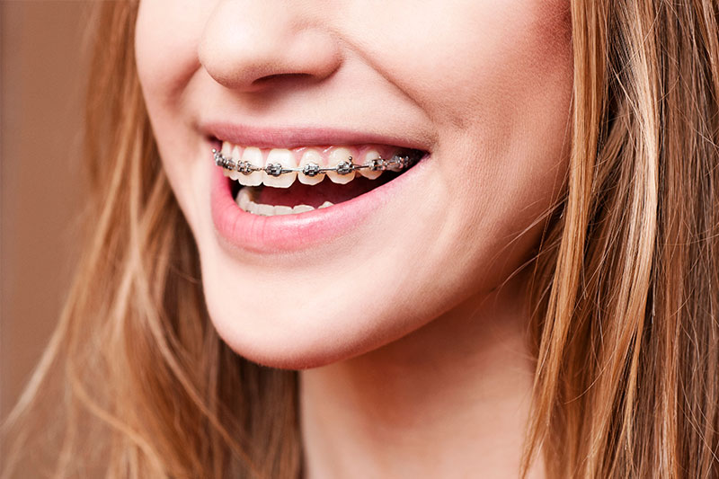 ارتودنسی دندان چیست و چه مشکلاتی را برطرف می کند؟