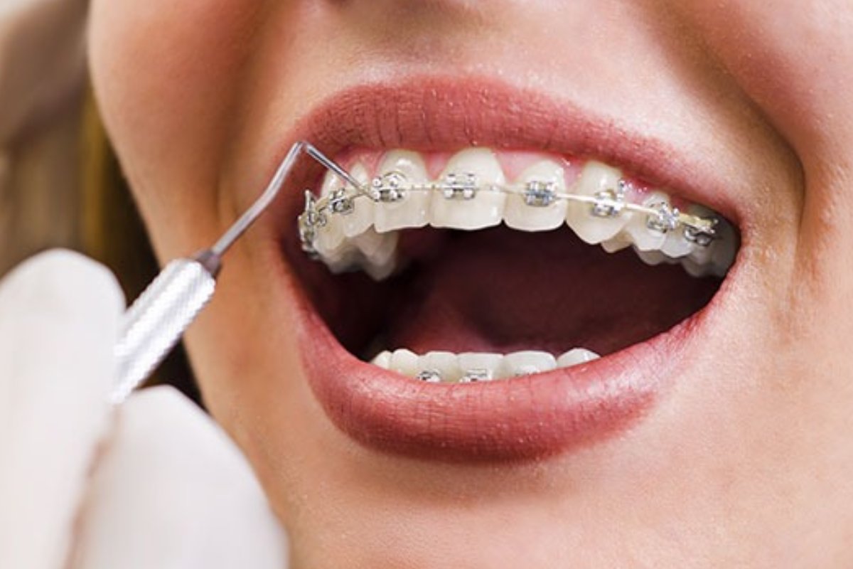 تحلیل قیمت ارتودنسی دندان