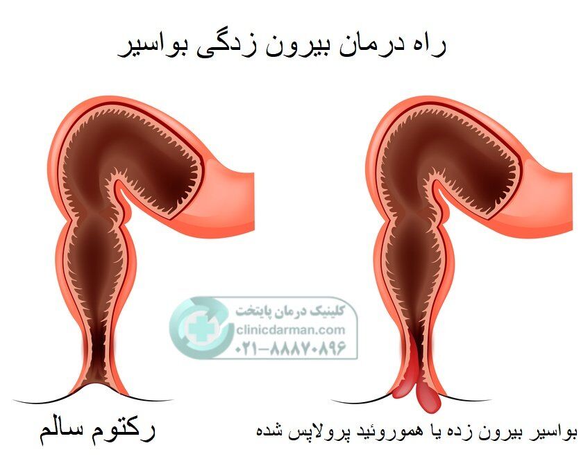 درمان بیرون زدگی بواسیر و معجزه طب سنتی در ۷ روز