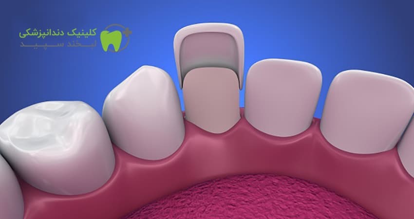 قیمت لمینت دندان در شرق تهران 