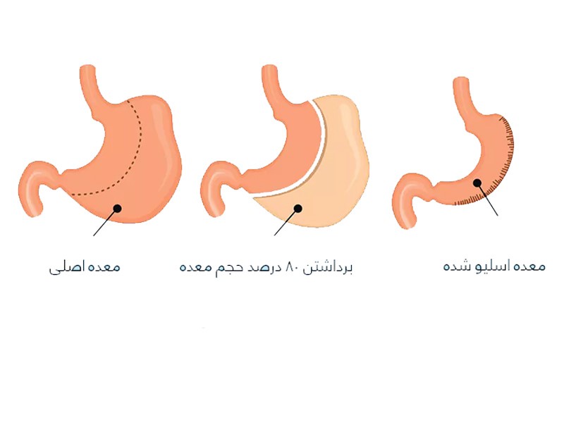 اسلیو معده چیست؟