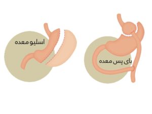 اسلیو با بای پس معده چه فرقی دارد؟