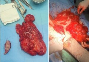 خارج کردن توده ۵ کیلویی از شکم خانم سنندجی!