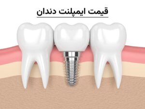 قیمت ایمپلنت دندان ۱۴۰۴ | هزینه انواع ایمپلنت در تهران