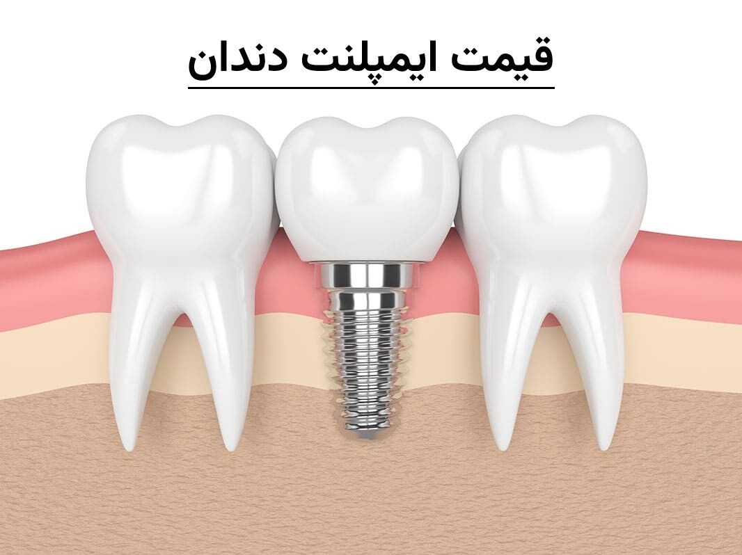 قیمت ایمپلنت دندان ۱۴۰۴ | هزینه انواع ایمپلنت در تهران