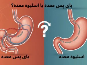 بایپس معده یا اسلیو معده ؟ بررسی تفاوت ها از نگاه بهترین جراح چاقی بایپس معده یا اسلیو معده ؟ بررسی تفاوت ها از نگاه بهترین جراح چاقی